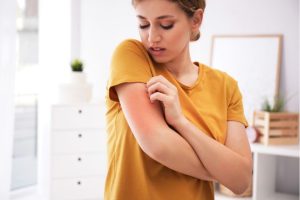 dermatitis atópica