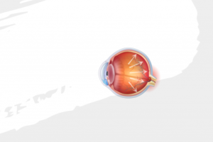 glaucoma